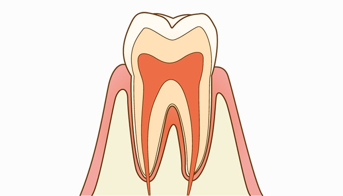 C0初期の虫歯