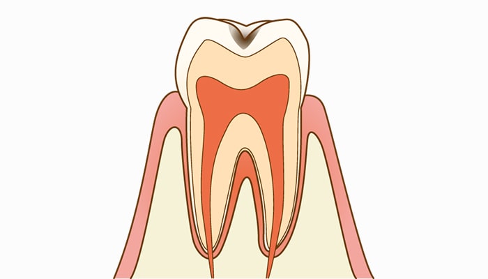 C1エナメル質の虫歯