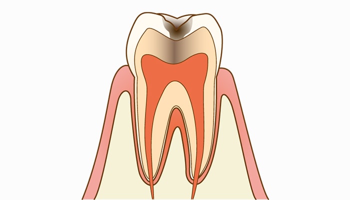 C2象牙質の虫歯