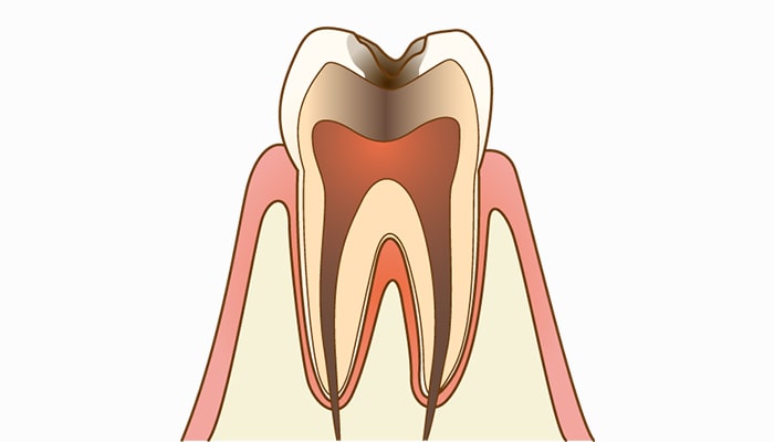 C3歯髄まで進行した虫歯