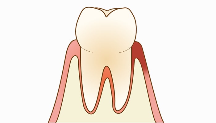 歯肉炎