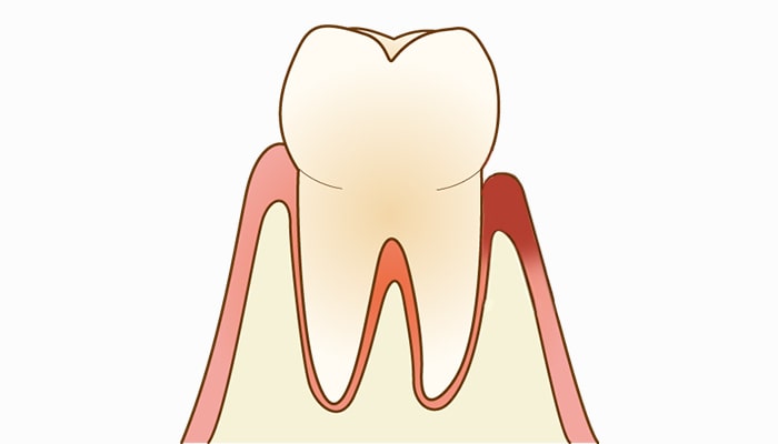 軽度歯周病